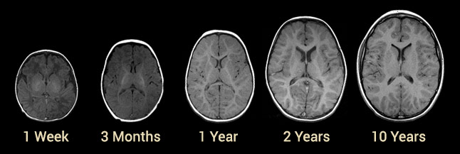 Brain sizes at 1 week, 3 months, 1 year, 2 years and 10 years