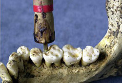 Skeletons reveal secrets of 9,000-year-old dentistry